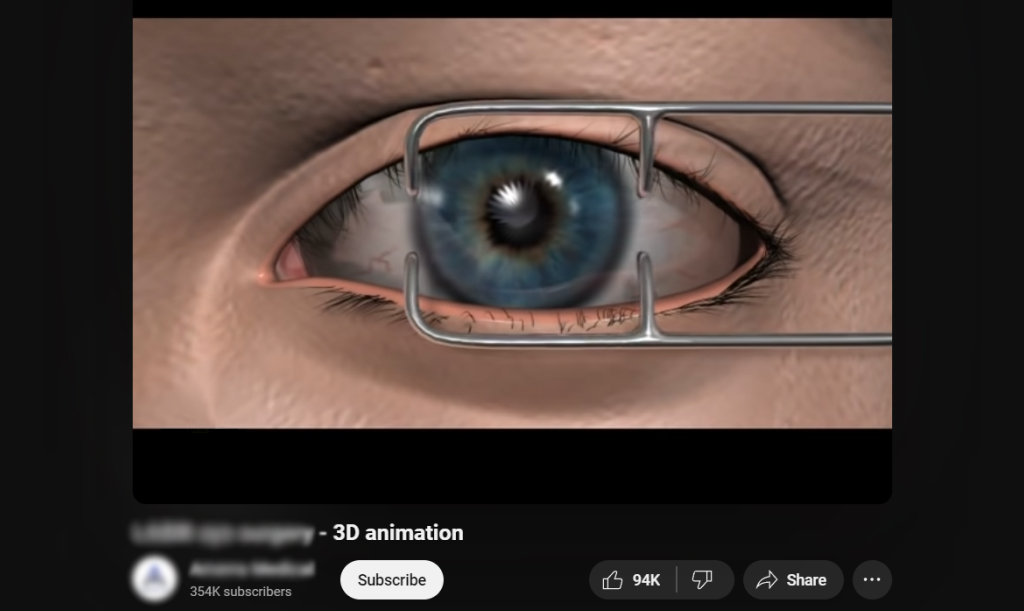 Explanation video about LASIK